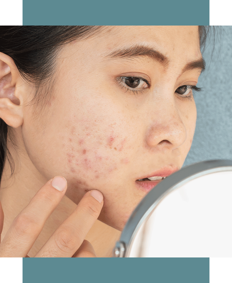 Trądzik czy to nie trądzik? - Orientana