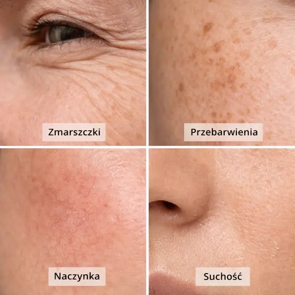 zdjęcie podzielone na cztery: oko ze zmarszczkami, przebarwienia na skórze, naczynka na skórze, sochość skóry koło nosa.