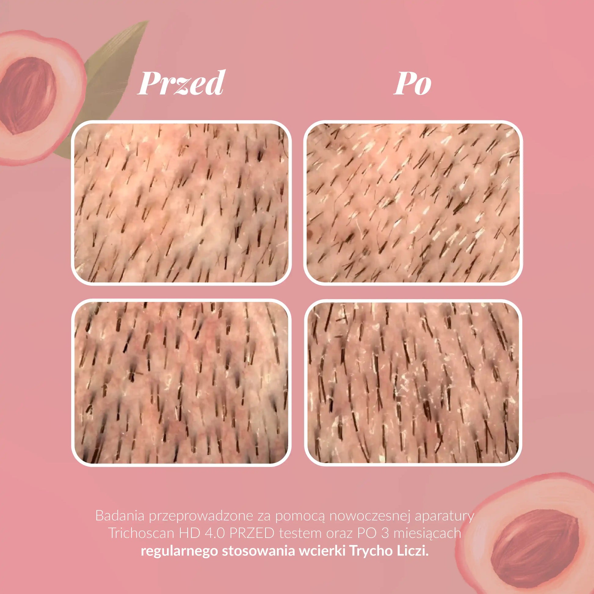 Efekt przed i po stosowaniu Trychologiczna wcierka do włosów Liczi Arginina Baicapil Mleczan Sodu 100 ml - Orientana badanie przeprowadzone za pomocą nowoczesnej aparatury Trichoscan HD 4.0