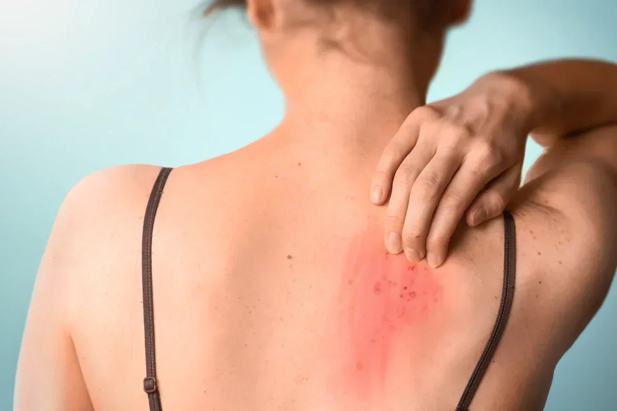 Czerwone plamy na ciele - przyczyny, objawy, diagnostyka i leczenie