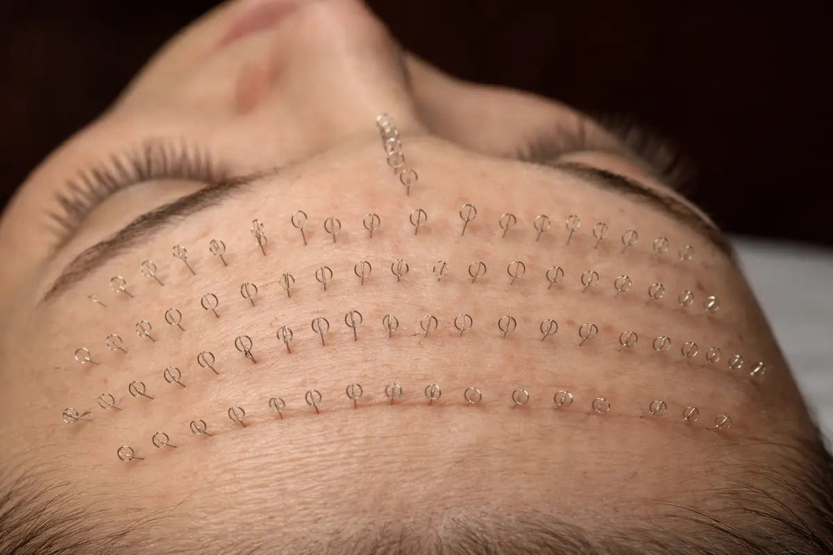 Pinezkowanie twarzy - nowy trend beauty czy niebezpieczny mit pielęgnacyjny?