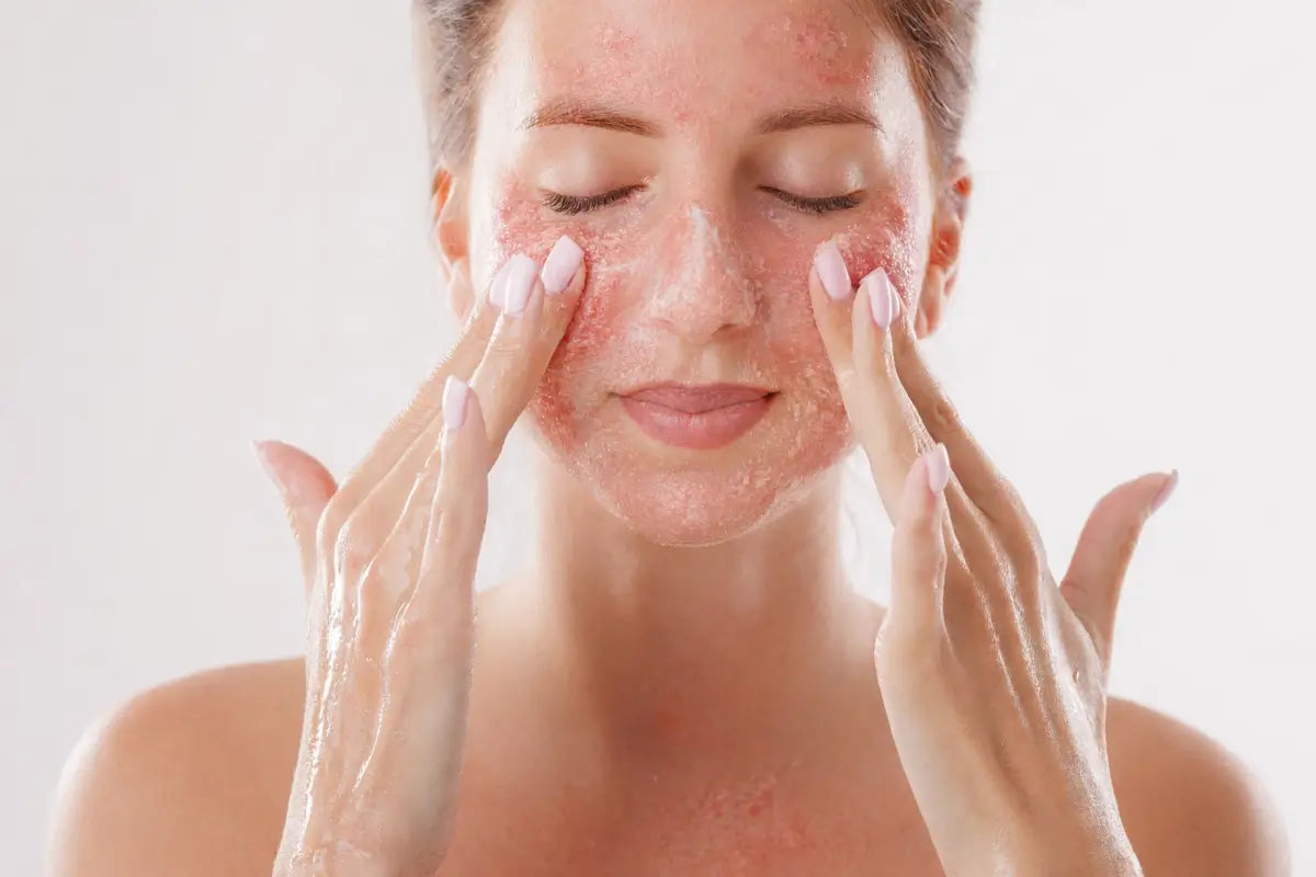 Wysyp po retinolu - Jak sobie z nim poradzić? Przewodnik i polecane produkty